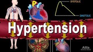 Hypertension - High Blood Pressure, Animation [d42767d5c]